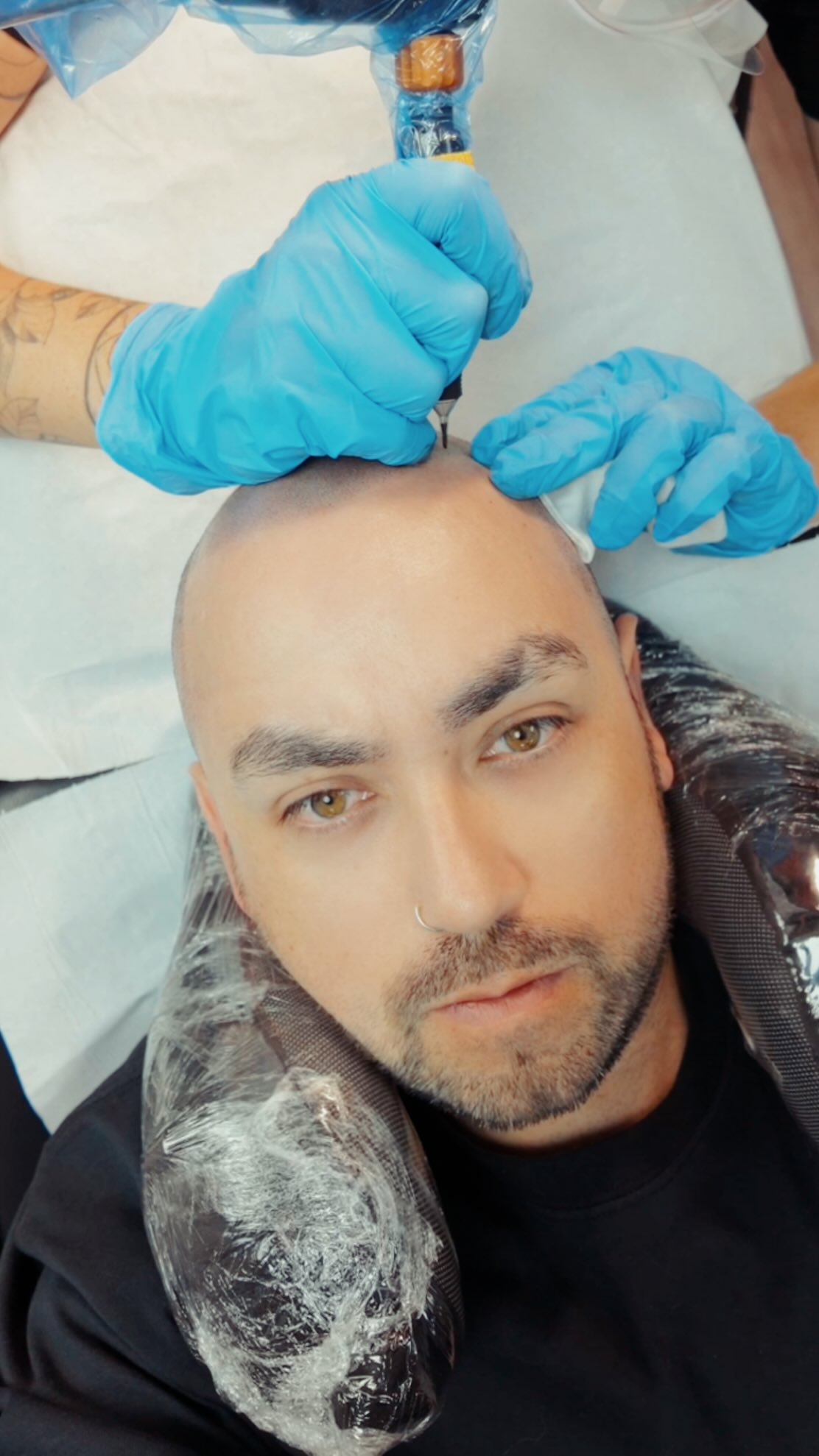 Cliente real de MicroScalp dos a&ntilde;os despu&eacute;s del procedimiento de micropigmentaci&oacute;n capilar efecto rapado