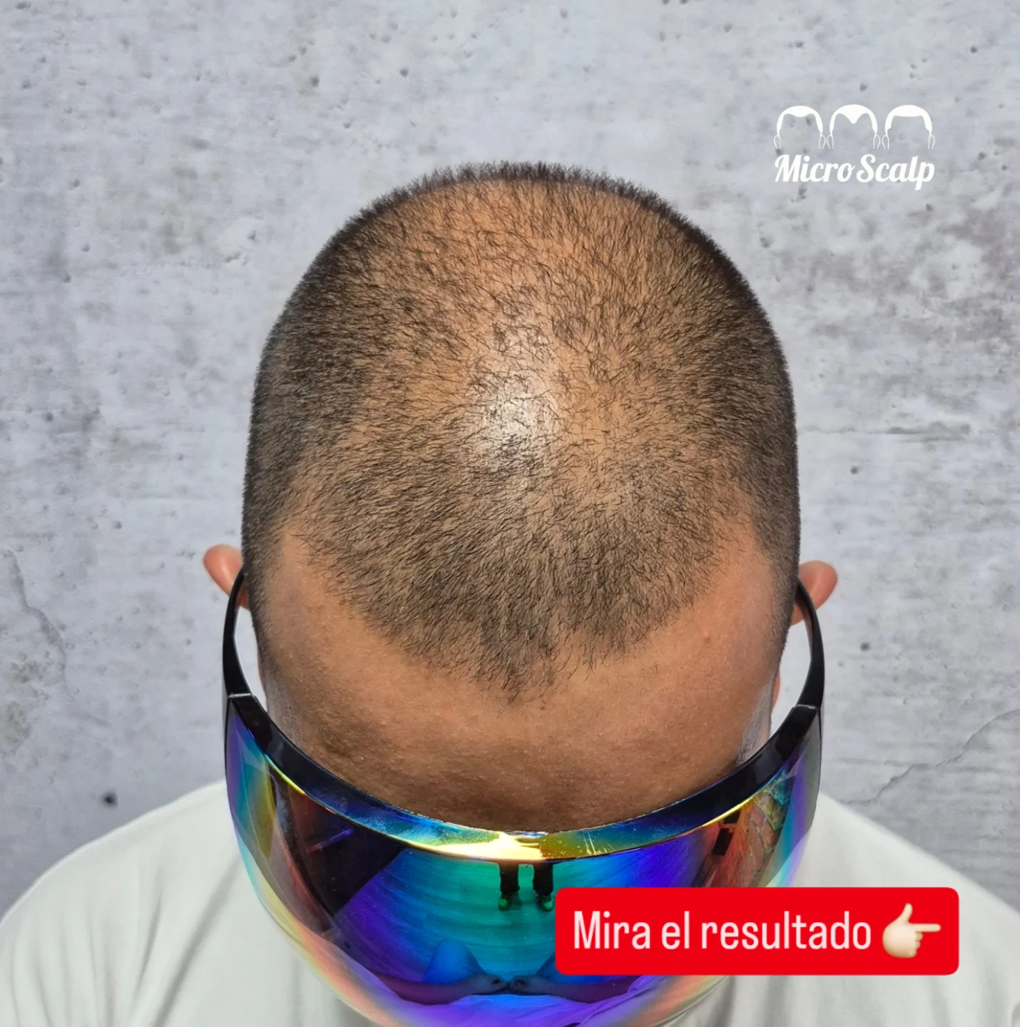 Efecto densidad capilar con cabello largo, t&eacute;cnica SMP para pelo fino sin necesidad de raparlo