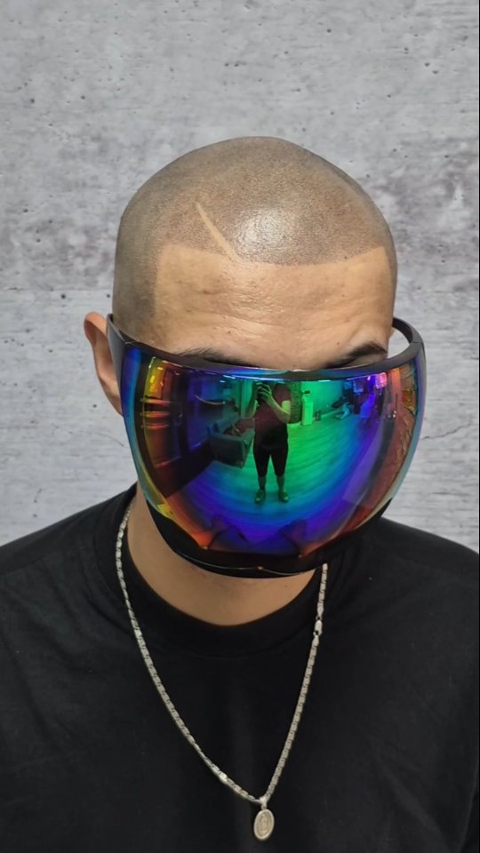 Camuflaje de placas de alopecia areata con micropigmentaci&oacute;n capilar de precisi&oacute;n