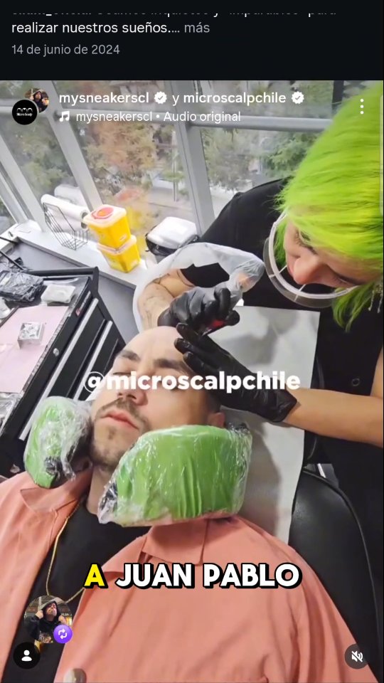 Influencer chileno con efecto rapado tras procedimiento SMP, caso p&uacute;blico